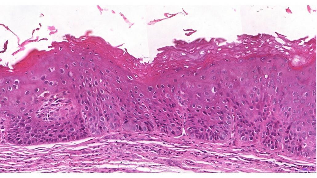 Leucoplasia Patologia Bucal