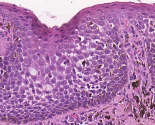 Imagem microscópica do melanoacantoma