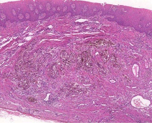 Imagem microscópica do melanoma