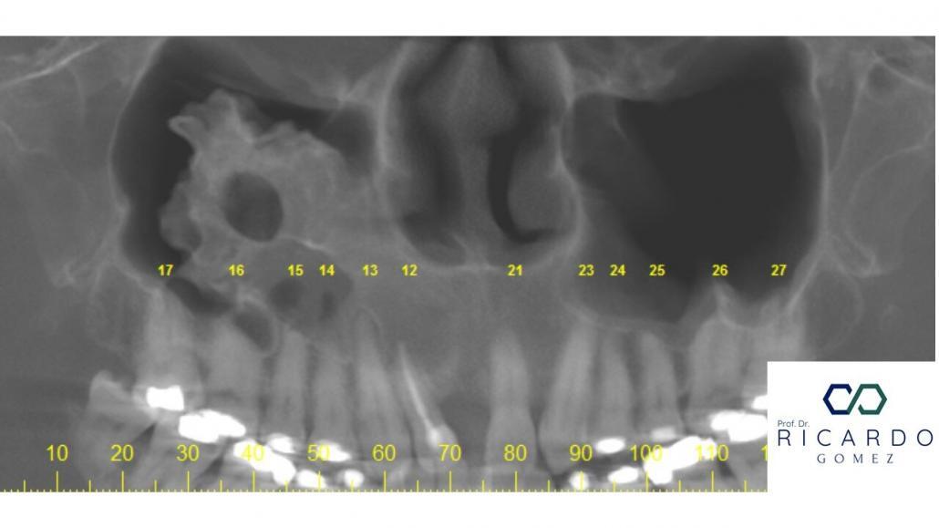 Imagem tomográfica da osteogênese reacional do seio maxilar