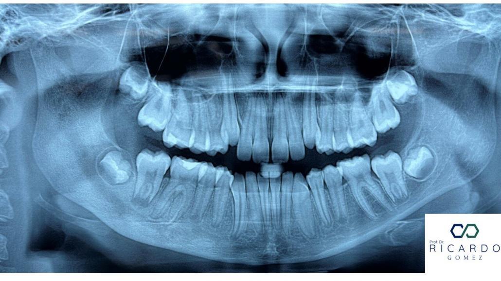 Imagem radiográfica da osteomielite crônica primária