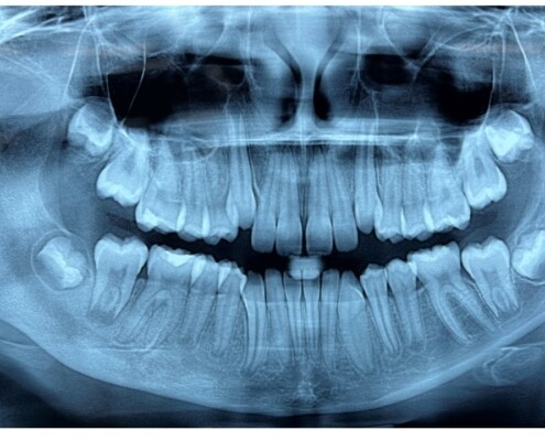 Imagem radiográfica da osteomielite crônica primária