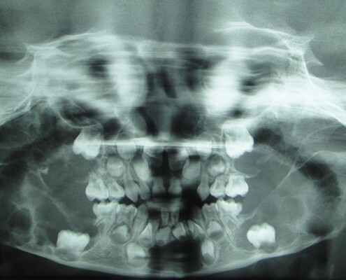 Imagem radiográfica do querubismo