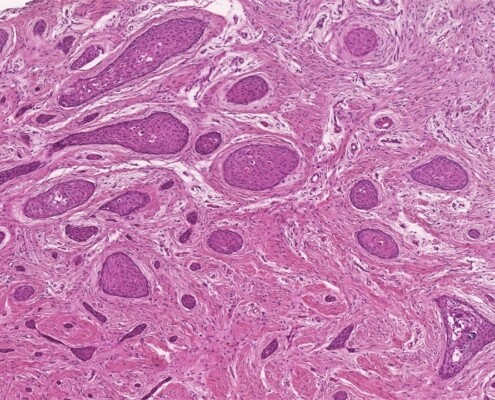 Imagem microscópica do tumor odontogênico escamoso